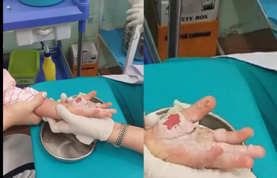 ХАВТАСТ ХЭРЭГ: Хүүхдийн гар индүүнд түлсэн цэцэрлэгийн багш Ц-г  500 мянган төгрөгөөр торгожээ