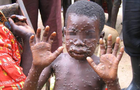 МОНКИФОКС вирусийн улмаас Хятадад нэг хүн нас баржээ