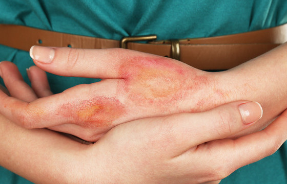 Хардалтын улмаас нөхрийгөө халуун усаар түлжээ