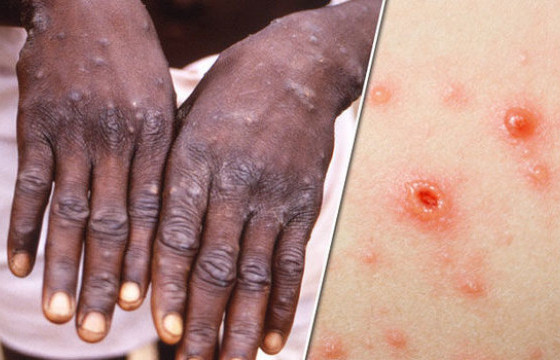 “Monkey pox” буюу сармагчны цэцэг өвчин