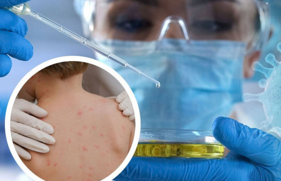 Сармагчны цэцэг өвчнөөр 21 хоногийн хугацаанд 780 хүн өвчилжээ