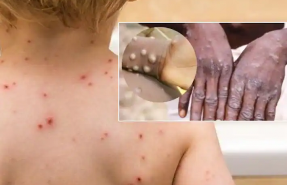 Турк Улсад сармагчны цэцэг өвчний анхны тохиолдол илэрчээ