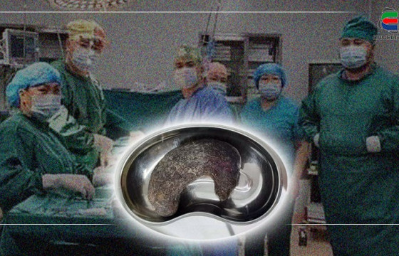 ДОРНОД АЙМГИЙН МЭС ЗАСЛЫН ЭМЧ Г.МЯГМАРДОРЖ: Үс иддэг ховор төрлийн өвчний улмаас үүссэн үслэгийн бөөгнөрөлийг зургаан настай охины ходоодноос гаргаж авлаа