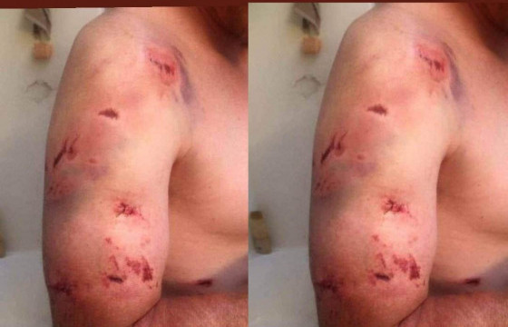 МАТАД СУМЫН ЭМЧ: Манай суманд чононд хазуулсан хүн ирээгүй