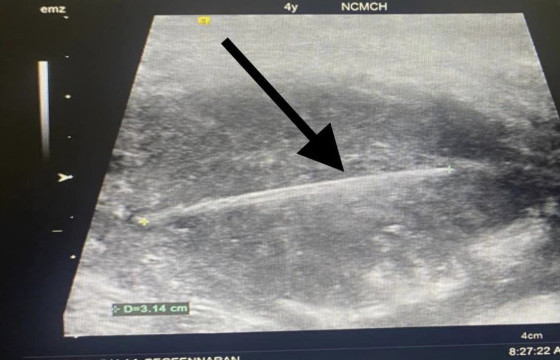  Шүдний чигчлүүр залгисан дөрвөн настай хүүхдэд ЭХЭМҮТ-ийн эмч нар яаралтай мэс засал хийжээ