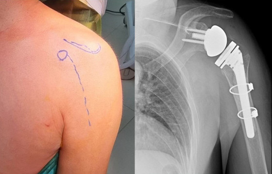  Мөрний үеийг бүтэн солих мэс заслын эмчилгээг Монголд нэвтрүүлжээ