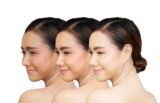 ЗӨВЛӨГӨӨ: Богино хугацаанд арьсаа цайруулах арга