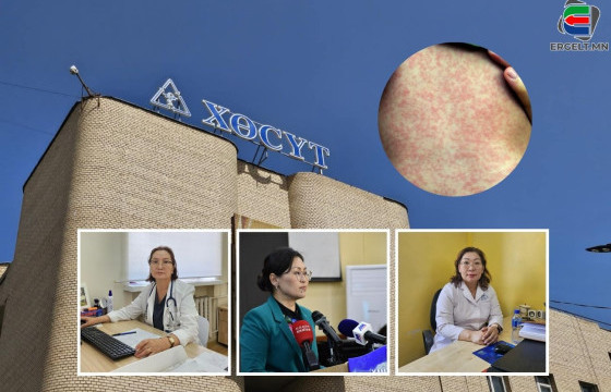 ДАРХЛААЖУУЛАЛТАД ХАМРАГДААГҮЙ ХҮН УЛААНБУРХАН ӨВЧНИЙ ХАЛДВАР АВСАН ХҮНТЭЙ ЗӨРӨХ ТӨДИЙД Л ХАЛДВАР АВАХ ЭРСДЭЛТЭЙ