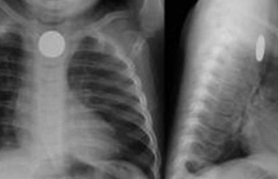 Бага насны хүүхэд товчин зай залгихаас урьдчилан сэргийлье