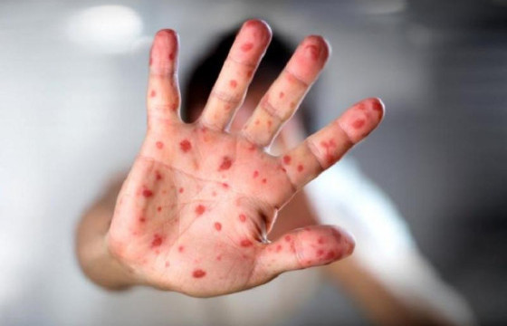 Вьетнам Улсад аялсан 5-38 насны гурван хүнээс улаанбурхан өвчин илэрчээ