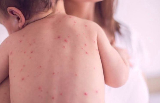 Улаанбурхан өвчний зургаа дахь тохиолдол бүртгэгджээ