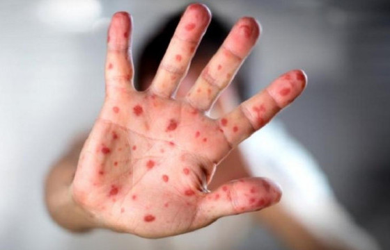 Улаанбурхан өвчний лабораториор батлагдсан тохиолдол 505 болжээ