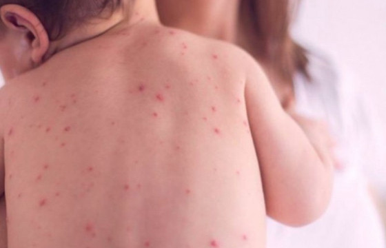 Улаанбурхан өвчний лабораториор батлагдсан тохиолдол 6265 болжээ