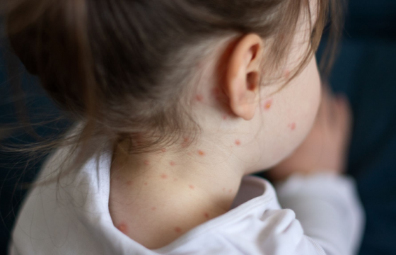 Улаанбурхан өвчний батлагдсан тохиолдол 11665 хүрчээ