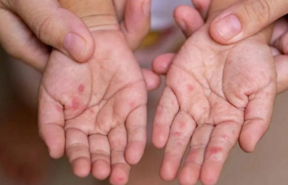 Улаанбурхан өвчний нийт батлагдсан тохиолдол 13149 болжээ