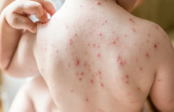 УЛААНБУРХАН ӨВЧНИЙ БАТЛАГДСАН ТОХИОЛДОЛ 13171 БОЛЛОО