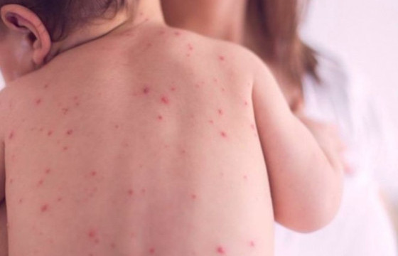 ХӨСҮТ: Улаанбурхан өвчний нийт батлагдсан тохиолдол 13442 болжээ