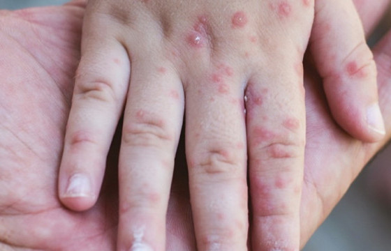 Улаанбурхан өвчний нийт батлагдсан тохиолдол 13541 болжээ