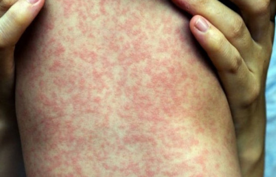 Улаанбурхан өвчний батлагдсан тохиолдол 13548 боллоо