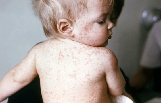 Улаанбурхан өвчний нийт батлагдсан тохиолдол 13628 болжээ