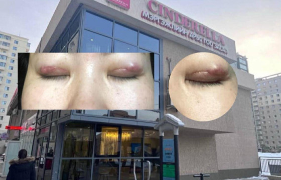 Синдерелла мэс заслын эмнэлэг: Манайд нүдний сүв гэмтээсэн талаар ямар ч гомдол ирээгүй