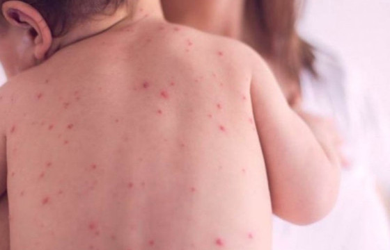 ХӨСҮТ: Улаанбурхан өвчний гурван шинэ тохиолдол батлагджээ