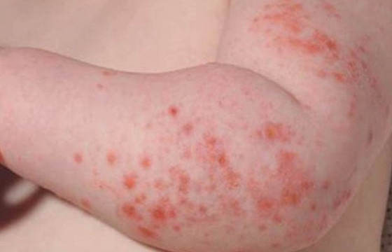 Дархан-Уул аймагт менингококкт өвчний тохиолдол бүртгэгджээ